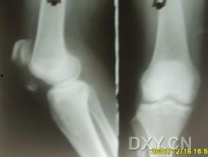 取克氏针视频,克氏针取针操作步骤详解视频